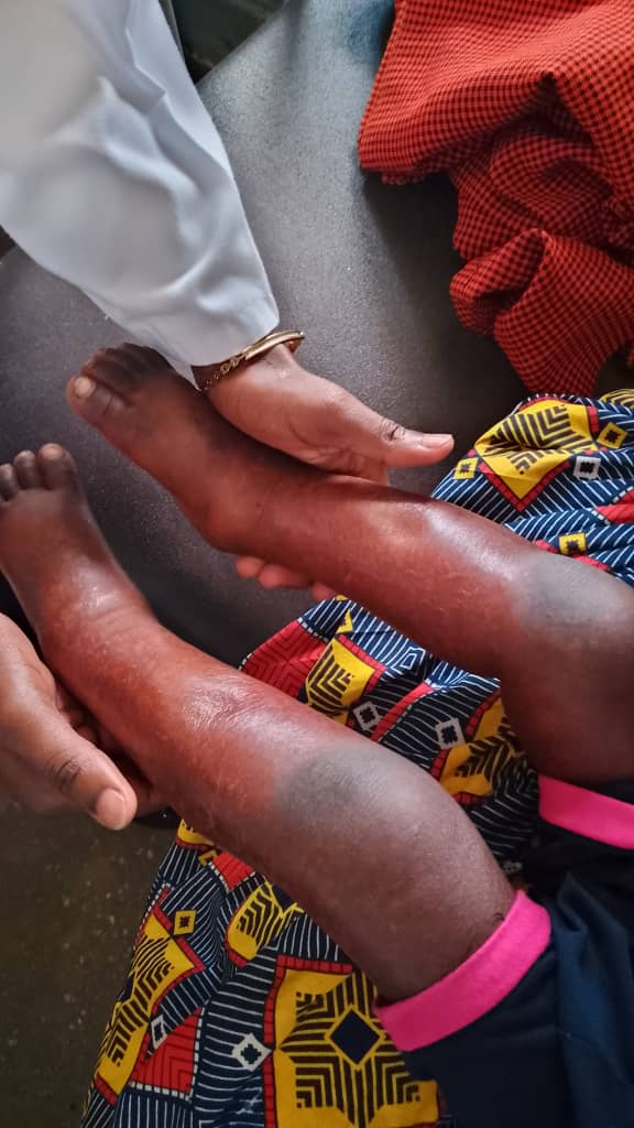 A clinician's hands supporting a child's swollen lower legs during a nutrition assessment, a sign of severe malnutrition.